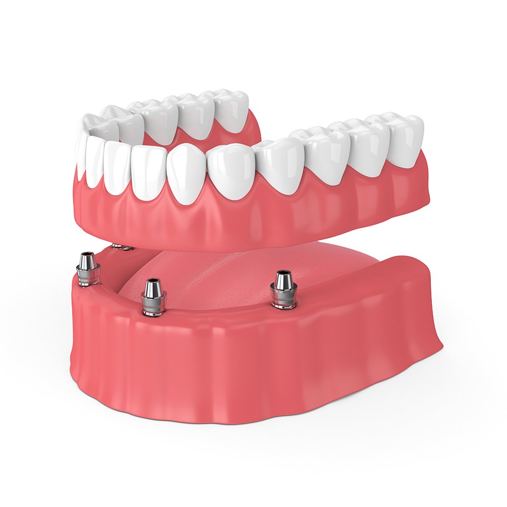 Denture Implants near me