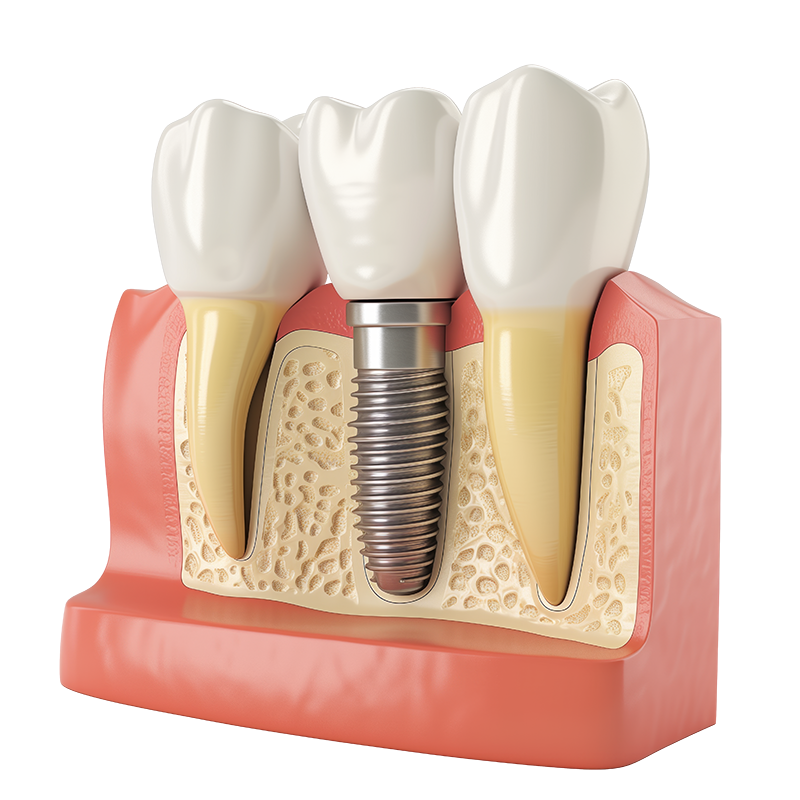 Bone Grafting near me in La Habra