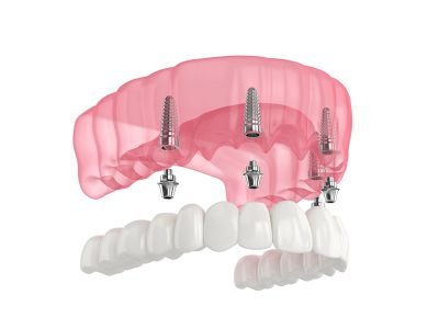 Mandibular prosthesis all on 4 system supported by over white background