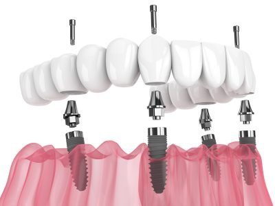 Mandibular prosthesis all on 4 system supported by implants over white background